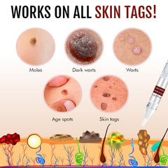 LOVILDS Tags & Moles Remover
