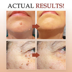 LOVILDS Tags & Moles Remover
